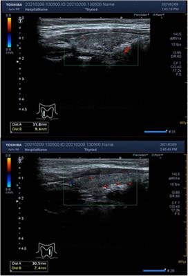 Case report: A case of immune thrombocytopenia combined with Hashimoto's thyroiditis and Helicobacter pylori infection in a child